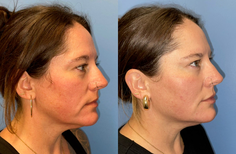 before and after facial rejuvenation