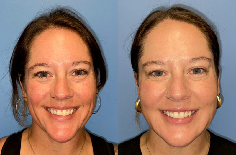 before and after facial rejuvenation