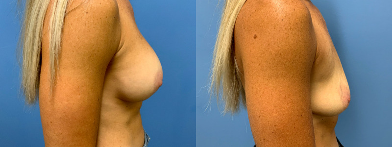 before and after implant removal